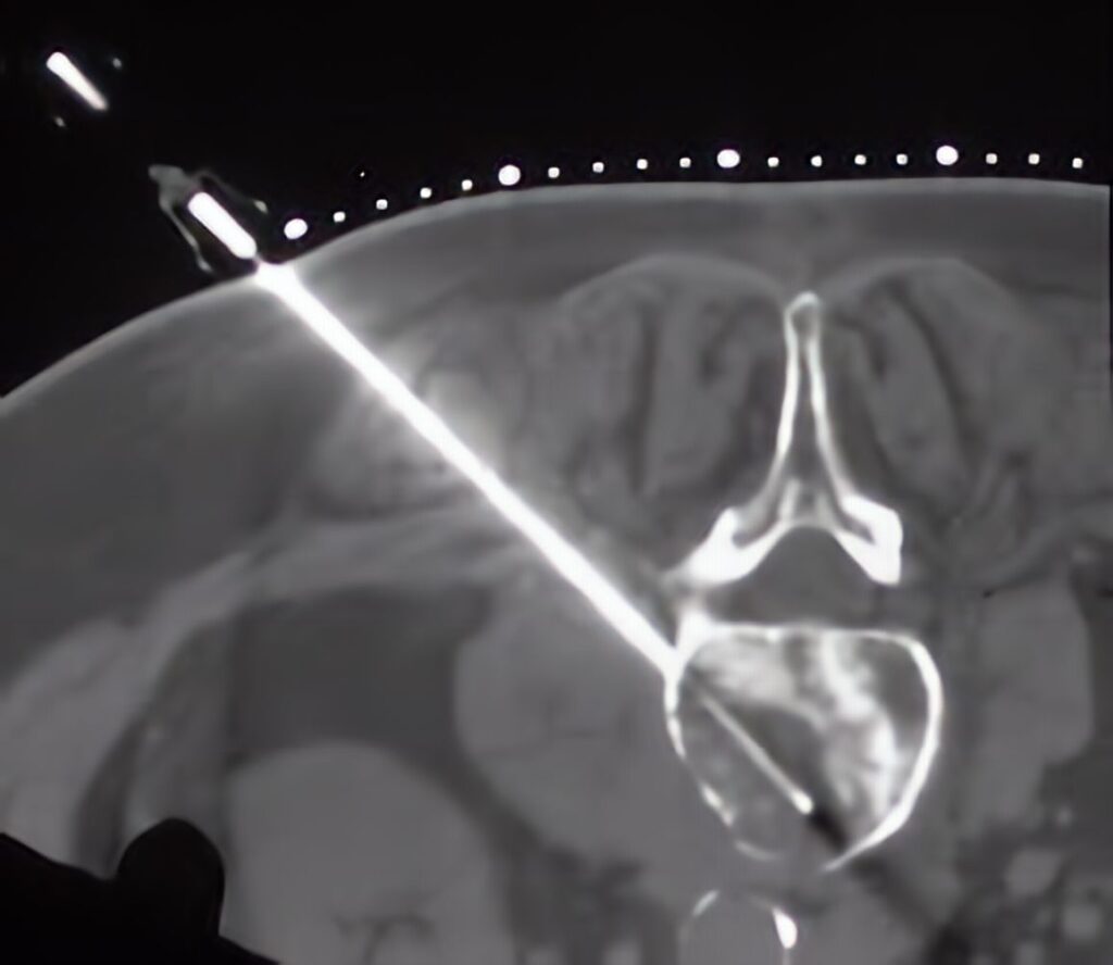 Boneopty Bone Biopsy System