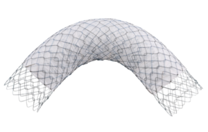 pyloric d-type Uncovered Stent