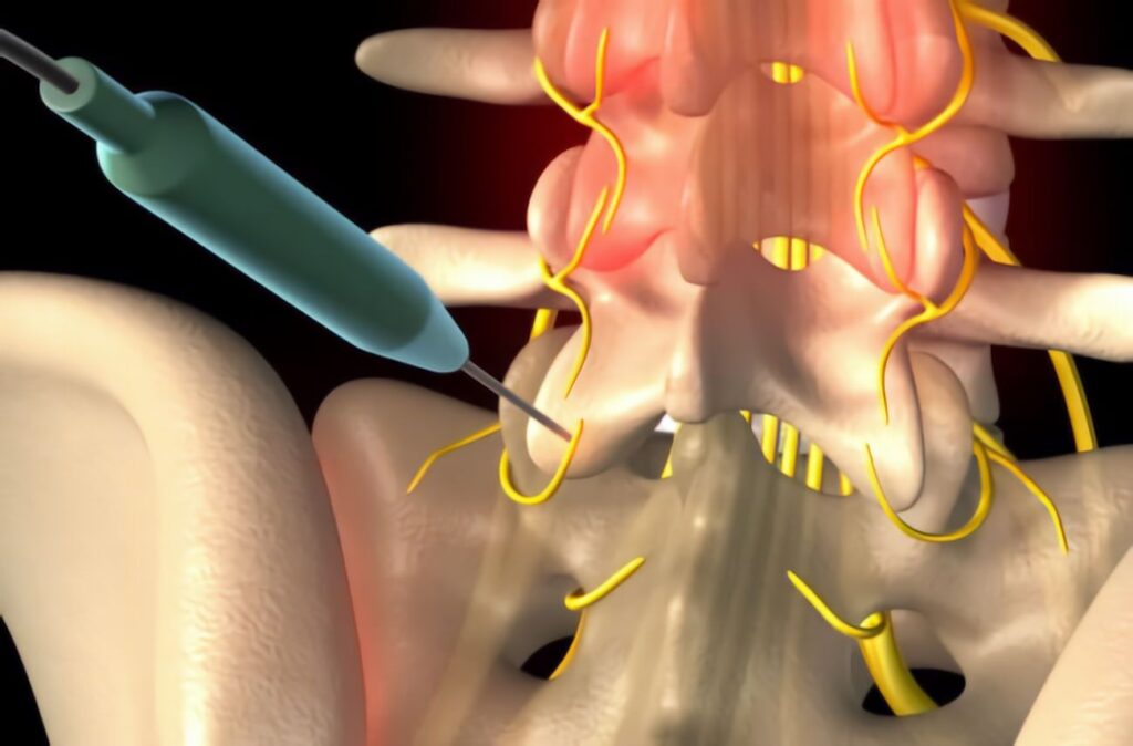 Interventional Radiology RF treatment