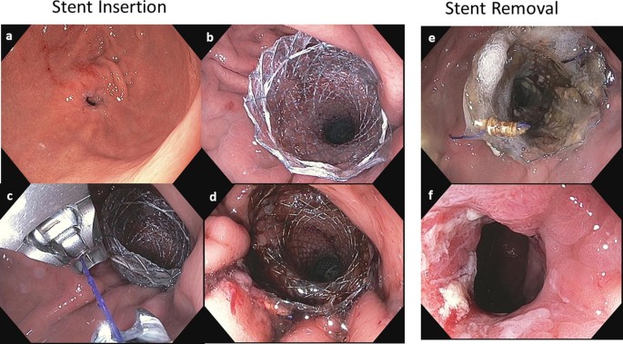 esophageal stent insertion