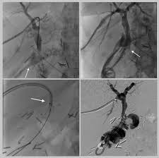interventional radiology stent placement